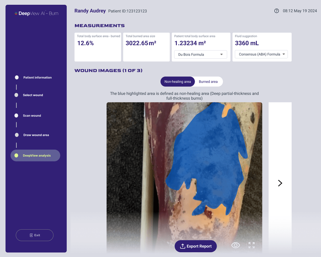 New DeepView analysis with color overlays, TBSA data, fluid resuscitation suggestions and plain-language explanations