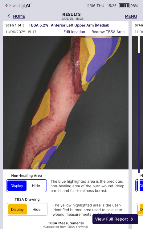 Simple on/off toggles for non-healing and TBSA overlays, removing the appearance of a confidence control