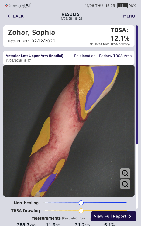 Continuous transparency sliders for non-healing and TBSA overlays, mistaken by users for AI confidence controls